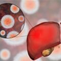 Hepatitis A