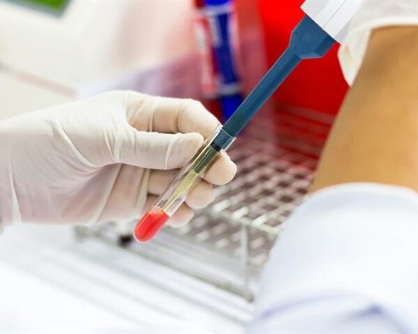 New Blood Test Offers Hope Early Detection of Alzheimer’s in Over 7 Million Americans