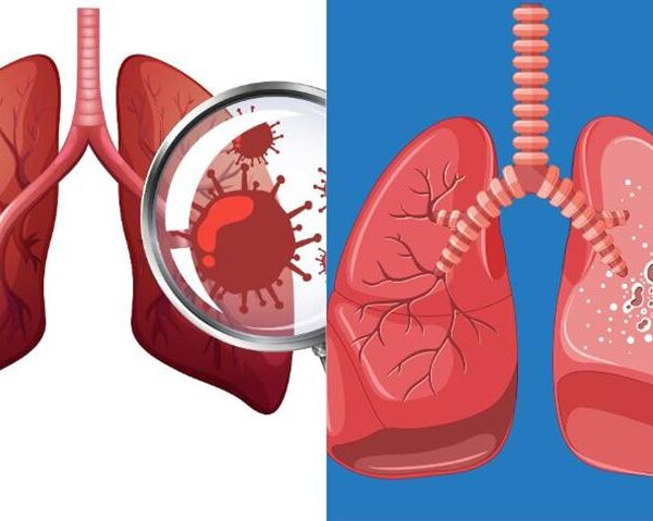TB or Lung Cancer Key Symptoms, Critical Differences, and Why Misdiagnosis Can Be Life-Threatening