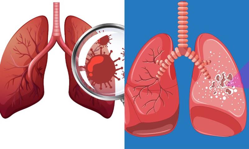 TB or Lung Cancer Key Symptoms, Critical Differences, and Why Misdiagnosis Can Be Life-Threatening