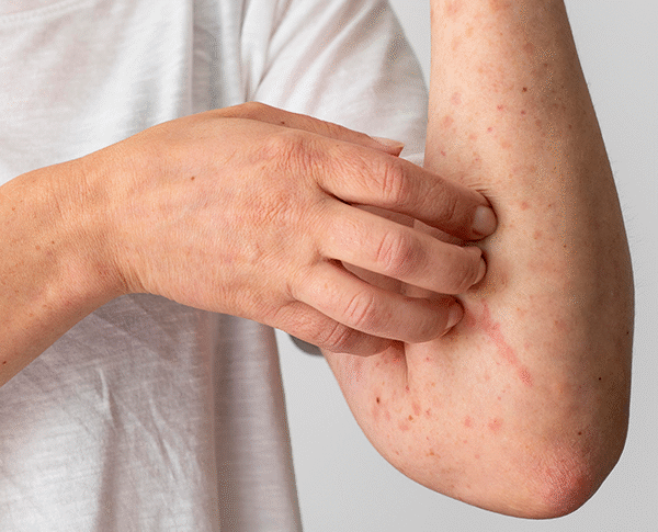 Your Skin Rash Might Be Sending a Warning to Your Joints