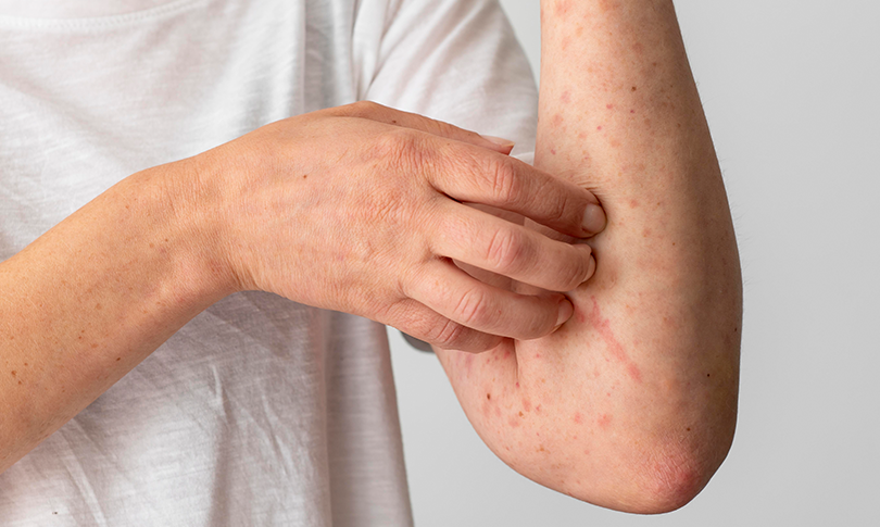 Your Skin Rash Might Be Sending a Warning to Your Joints
