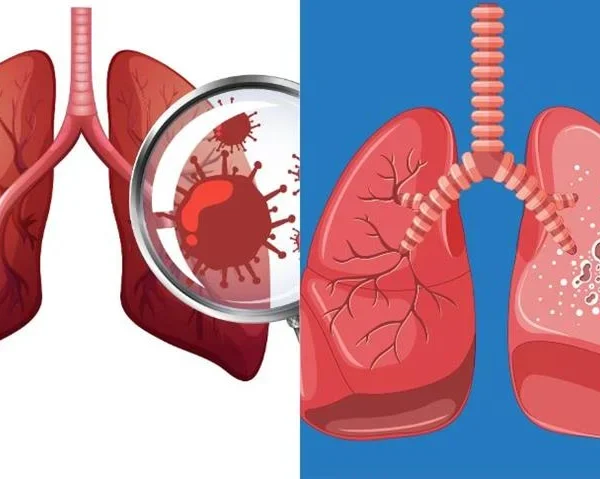 JOSH Teams to Expand Across 55 Districts in 11 States to Raise TB Awareness